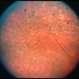 Congenital Nyctalopia